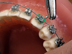 A Brief About Orthodontics